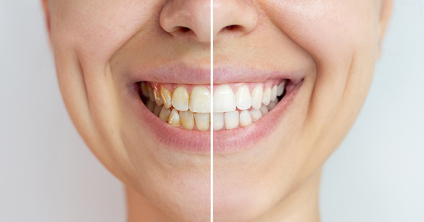 Is teeth whitening right for you - Pros and cons