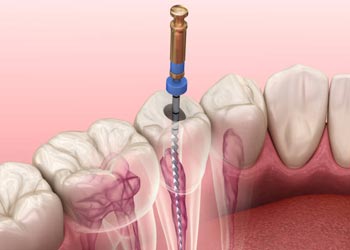 root research endodontics in Vijayawada